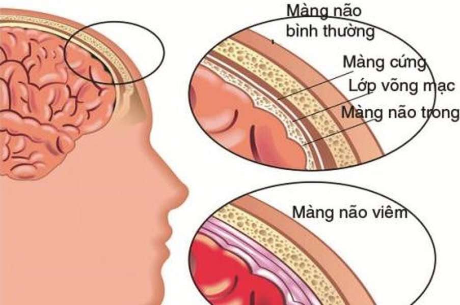 Bệnh cồn kinh cách phân biệt xử trí và đầy đủ điều cần tránh Bệnh cồn kinh cách nhận biết xử trí và mọi điều cần tránh
