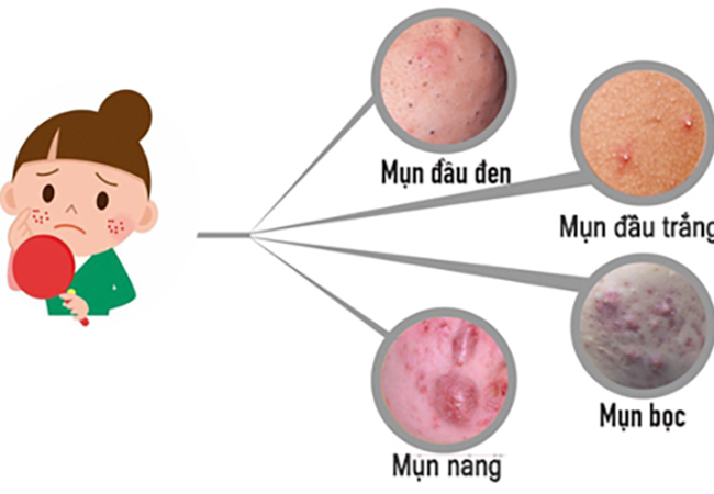 ChĂm sÓc da tuỔi dẬy thÌ ĐÚng cÁch ChĂm sÓc da tuỔi dẬy thÌ ĐÚng cÁch