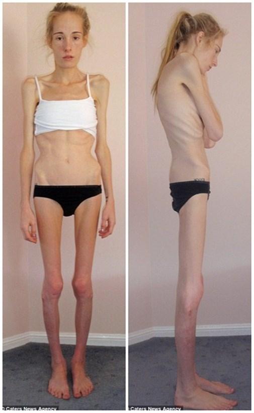 Chán ăn uống là thèm dung dịch lời cảnh tỉnh đến hội ăn uống kiêng