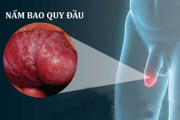 Tất tần tật về mộc nhĩ candida ở nam giới dấu hiệu và giải pháp chữa Tất tần tật về mộc nhĩ candida ở nam giới dấu hiệu và giải pháp chữa