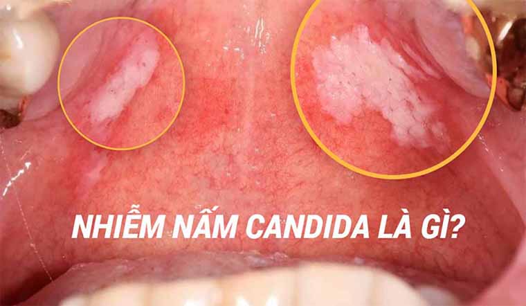 Bệnh mộc nhĩ candida Ở phái nam và giải pháp Điều trị cập nhật Bệnh mộc nhĩ candida Ở phái nam và phương pháp Điều trị cập nhật