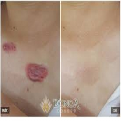 Chữa sẹo lồi ở viện có tốt không Chữa sẹo lồi sinh sống viện có tốt không