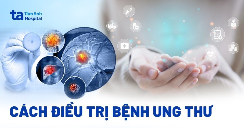 Cách điều trị ung thư phổ biến kết quả cao hiện nay nay Cách điều trị ung thư phổ biến hiệu quả cao hiện nay