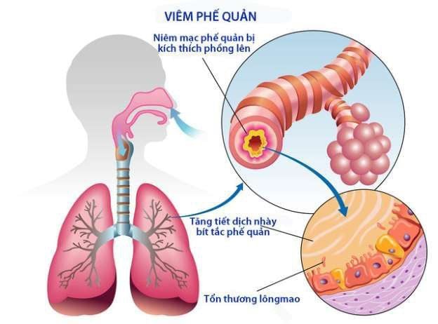 Cách trị viêm phế quản không sử dụng kháng sinh Cách trị viêm phế truất quản không sử dụng kháng sinh