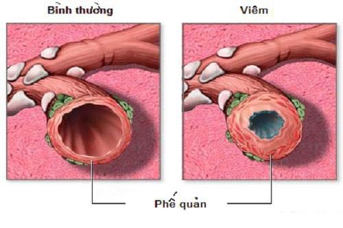 Viêm phế truất quản cung cấp ở người lớn có thể hiện như cụ nào Viêm truất phế quản cấp cho ở tín đồ lớn có thể hiện như cố gắng nào