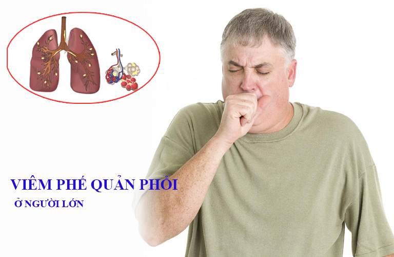Viêm phế truất quản phổi Ở fan lớn Điều trị như nào hiệu quả Viêm truất phế quản phổi Ở tín đồ lớn Điều trị như như thế nào hiệu quả
