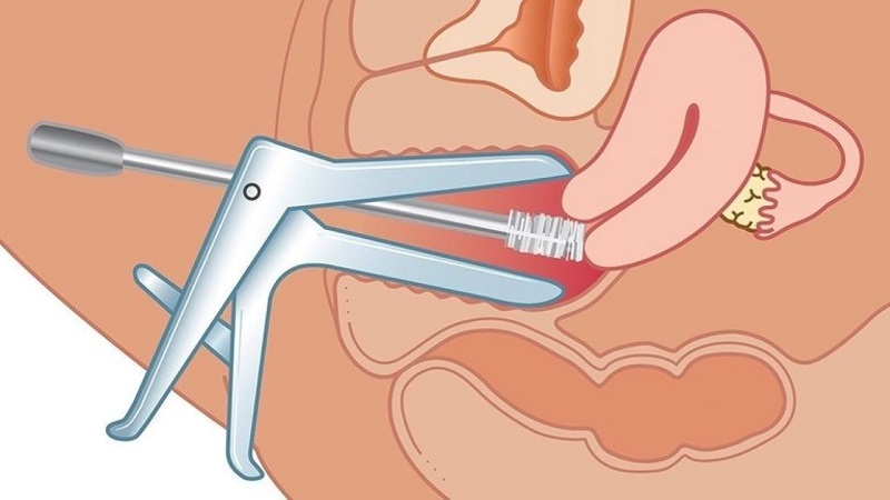 Trước khi đi khám phụ khoa bạn nữ nên biết điều này Trước khi đi khám phụ khoa bạn nữ nên biết điều này