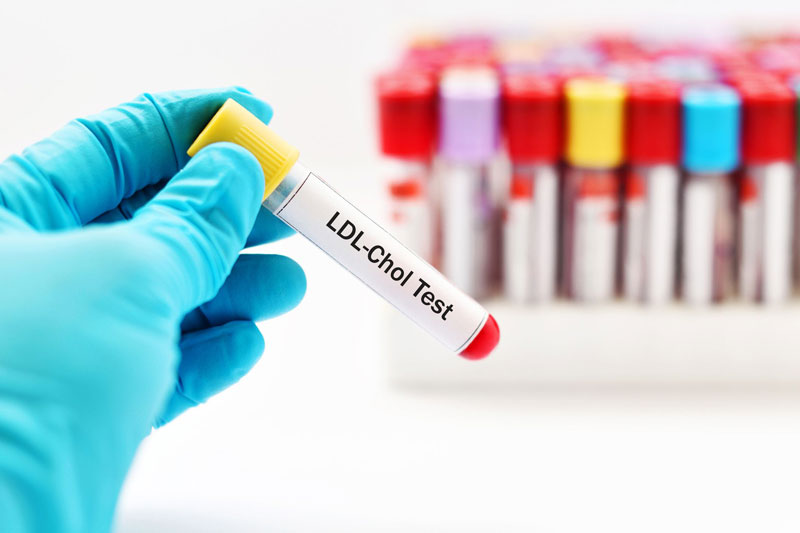 Xét nghiệm ldl là gì Xét nghiệm ldl là gì