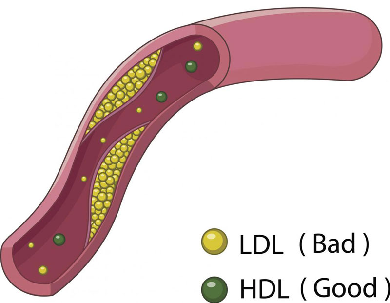 Xét nghiệm ldl là gì Xét nghiệm ldl là gì