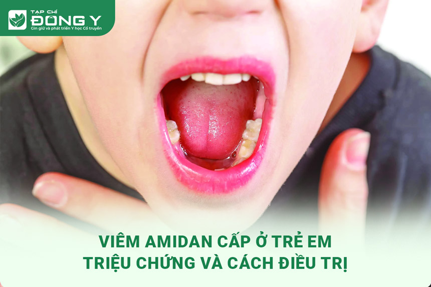 Phác đồ điều trị viêm amidan cấp ở trẻ em