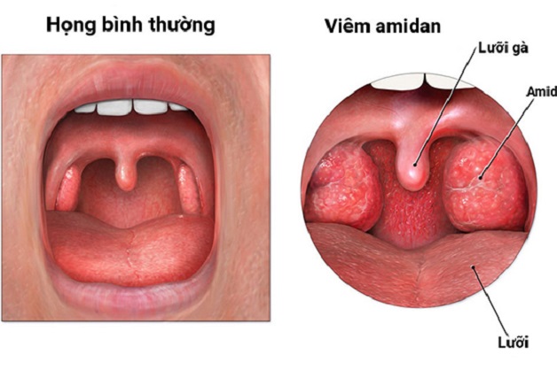 Độ tuổi tuyệt mắc viêm amidan trường phù hợp nào phải và không nên cắt amidan Độ tuổi hay mắc viêm amidan trường phù hợp nào bắt buộc và không nên cắt amidan