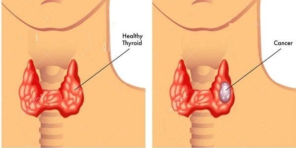 Sự thật về u tuyến giáp ác tính Sự thiệt về u tuyến tiếp giáp ác tính