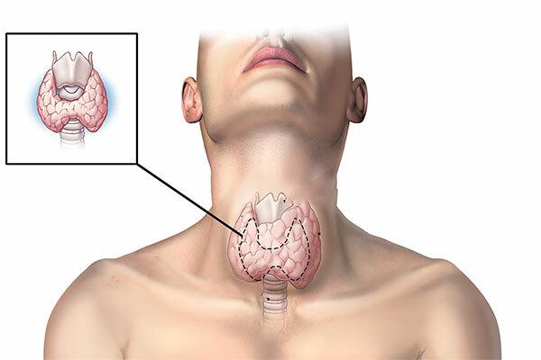 Phương hướng chữa ung thư tuyến cạnh bên hiện nay Phương hướng chữa ung thư tuyến cạnh bên hiện nay