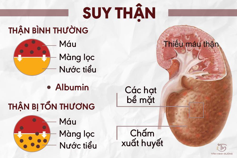Ý nghĩa chỉ số xét nghiệm creatinine trong chẩn đoán suy thận Ý nghĩa chỉ số xét nghiệm creatinine vào chẩn đoán suy thận