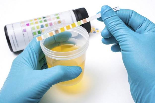 Xét nghiệm ketone có chân thành và ý nghĩa gì Xét nghiệm ketone có chân thành và ý nghĩa gì