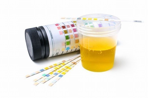Ý nghĩa của chỉ số ketone so với bệnh tè đường Ý nghĩa của chỉ số ketone đối với bệnh tiểu đường