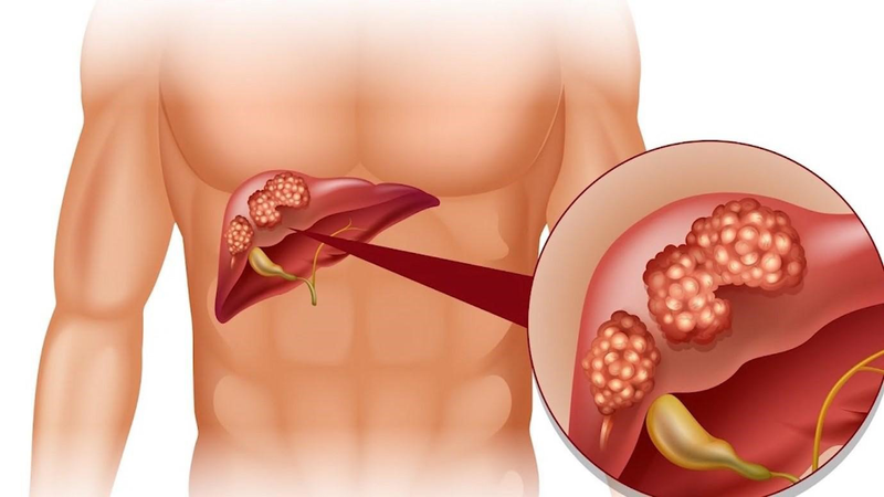 Chỉ số xét nghiệm sgot là gì Chỉ số xét nghiệm sgot là gì