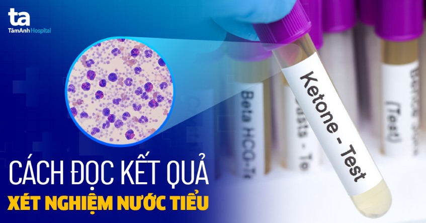 Hướng dẫn bí quyết đọc công dụng xét nghiệm nước tiểu dễ dàng nắm bắt nhất Hướng dẫn biện pháp đọc công dụng xét nghiệm nước tiểu dễ hiểu nhất